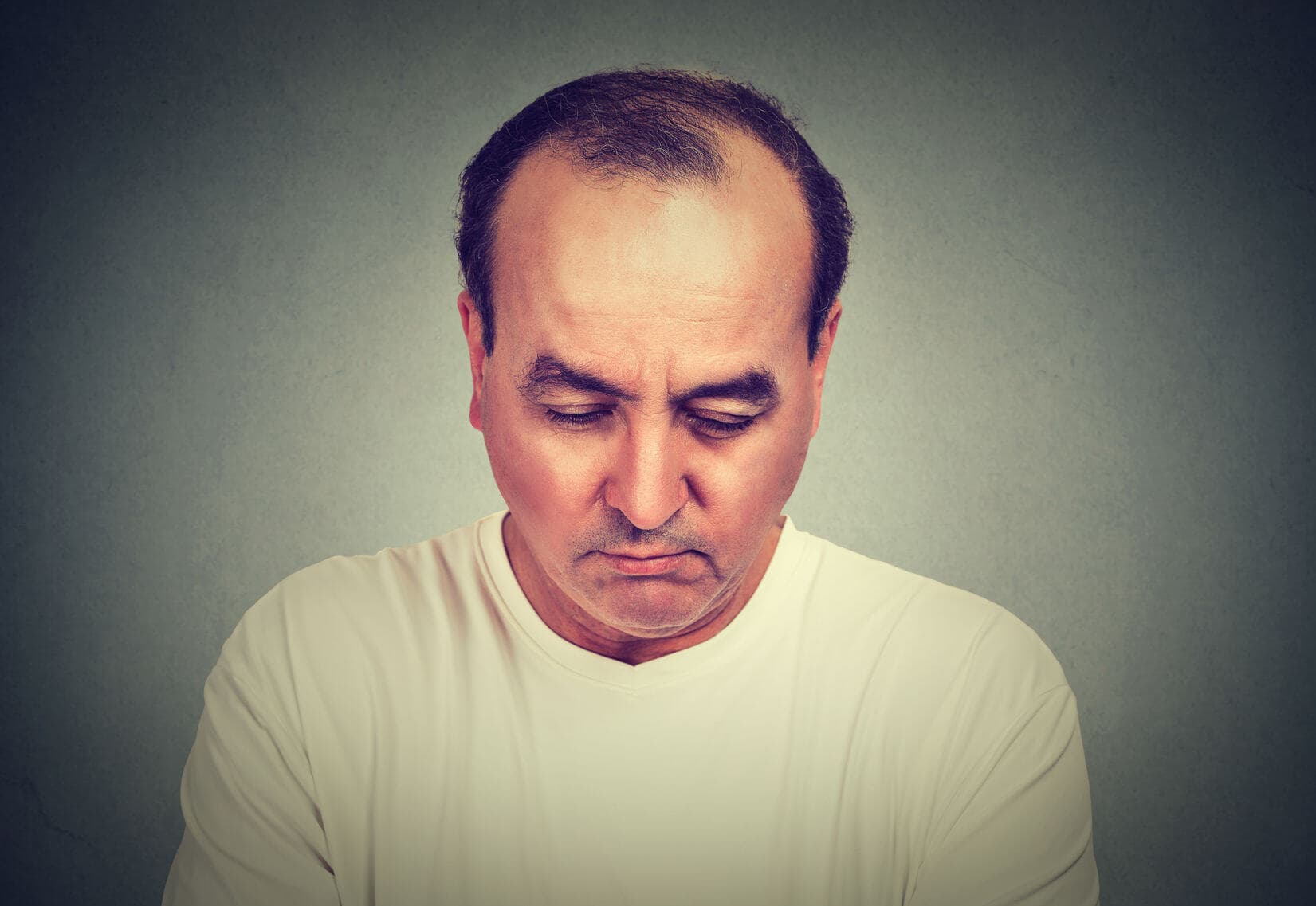 Łysienie androgenowe, co to? Przyczyny i leczenie łysienia androgenowego u mężczyzn i kobiet