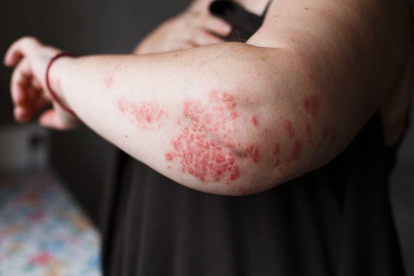 Łuszczyca krostkowa - leczenie, domowe sposoby i dieta