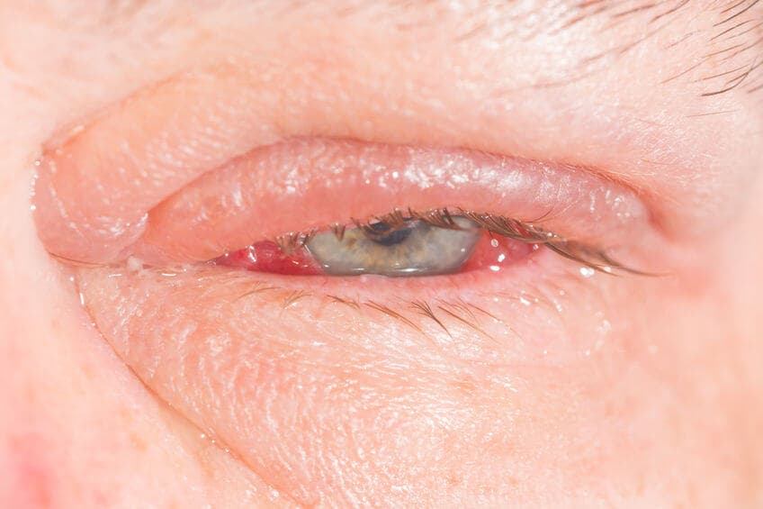 Ostre, przewlekłe i nawracające zapalenie spojówek: leczenie, objawy, leki