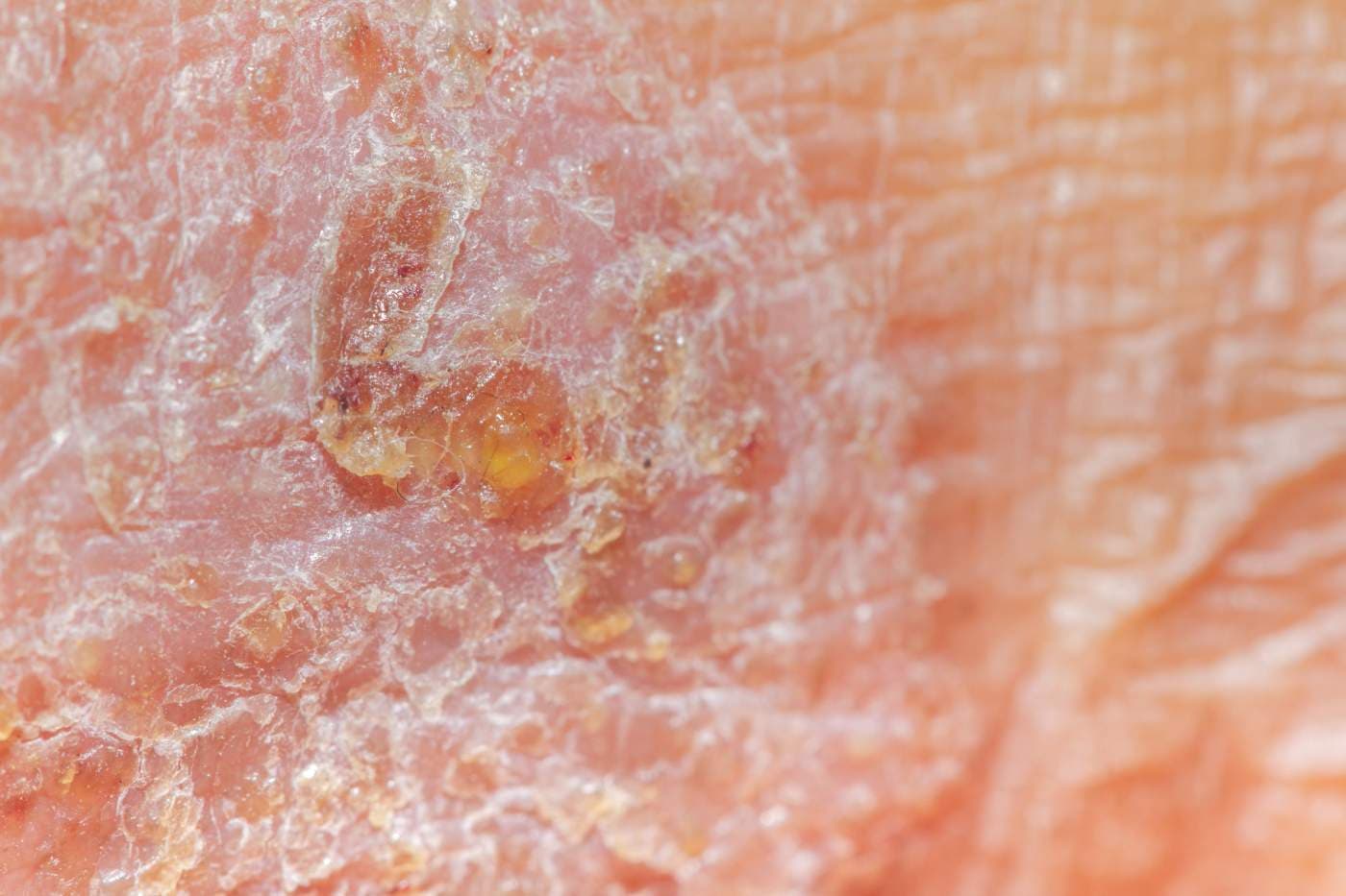 Liszajec zakaźny. Przyczyny, objawy, leczenie u dorosłych i dzieci