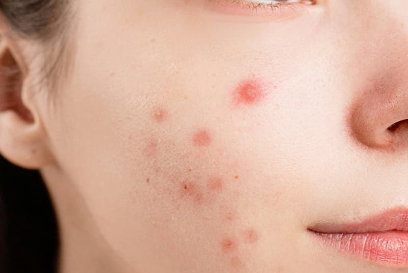 Czyrak: objawy, przyczyny, leczenie