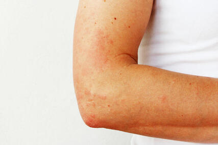 Alergia Objawy Przyczyny Leki Leczenie Dimedic Eu