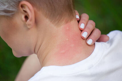 Alergia Objawy Przyczyny Leki Leczenie Dimedic Eu