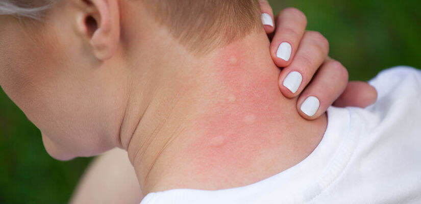 Alergia Skórna U Dzieci I Dorosłych Leczenie I Objawy Dimediceu 5476
