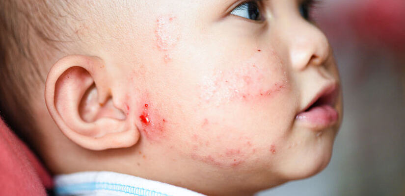 Alergia U Dzieci I Niemowlat Czym Sie Rozni I Kiedy Pojawiaja Sie Pierwsze Objawy Uczulenia